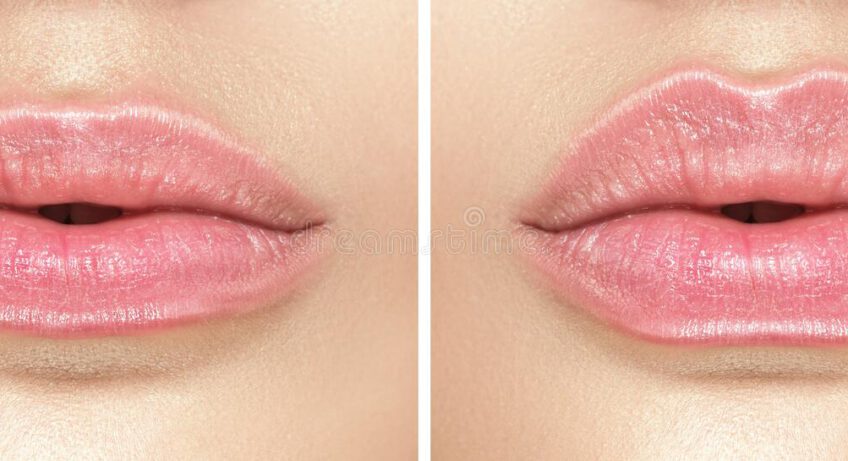 Hoe lipfillers je kunnen helpen vollere lippen te krijgen: alles wat je moet weten