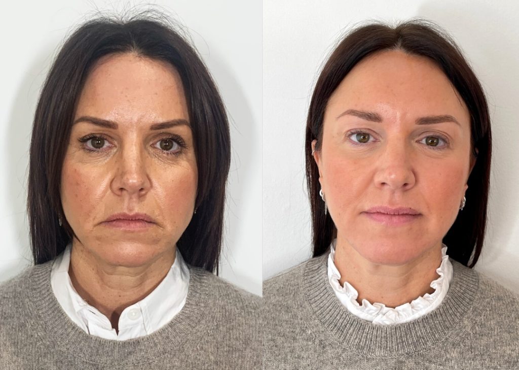 Op deze voor- en nafoto zie je hoe de mondhoeken voor de behandeling zichtbaar naar beneden zijn getrokken en rimpels rondom de lippen méér accentueren. Na het inzetten van botox in de mondhoeken is de gezichtsuitdrukking zachter en subtiel gelift, wat bijdraagt aan een frisse, jeugdige uitstraling. Dit resultaat onderstreept hoe esthetische injectables een effectieve huidverbetering bieden zonder ingrijpende ingrepen. Cosmetische klinieken kiezen steeds vaker voor deze voorzichtige benadering om mimische rimpels te verzachten en een natuurlijk effect te bereiken. Zo toont dit beeld duidelijk de impact van botox mondhoeken op een harmonieuze, stralende look.